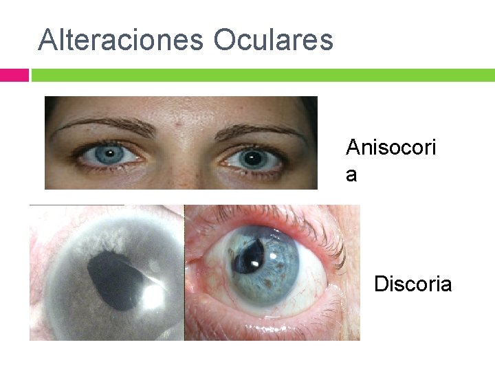 Alteraciones Oculares Anisocori a Discoria 