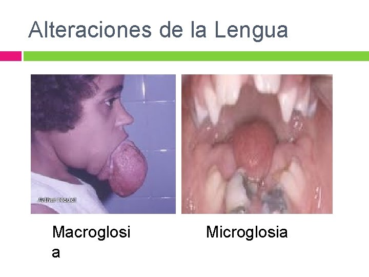 Alteraciones de la Lengua Macroglosi a Microglosia 