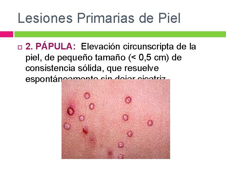 Lesiones Primarias de Piel 2. PÁPULA: Elevación circunscripta de la piel, de pequeño tamaño