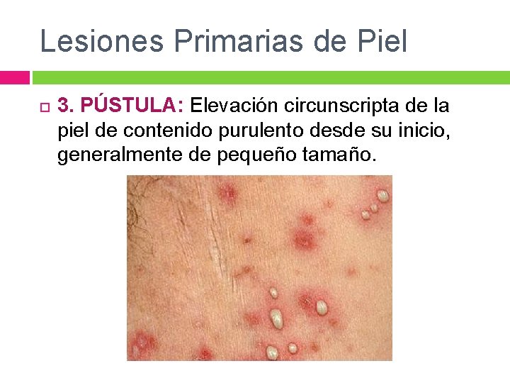 Lesiones Primarias de Piel 3. PÚSTULA: Elevación circunscripta de la piel de contenido purulento