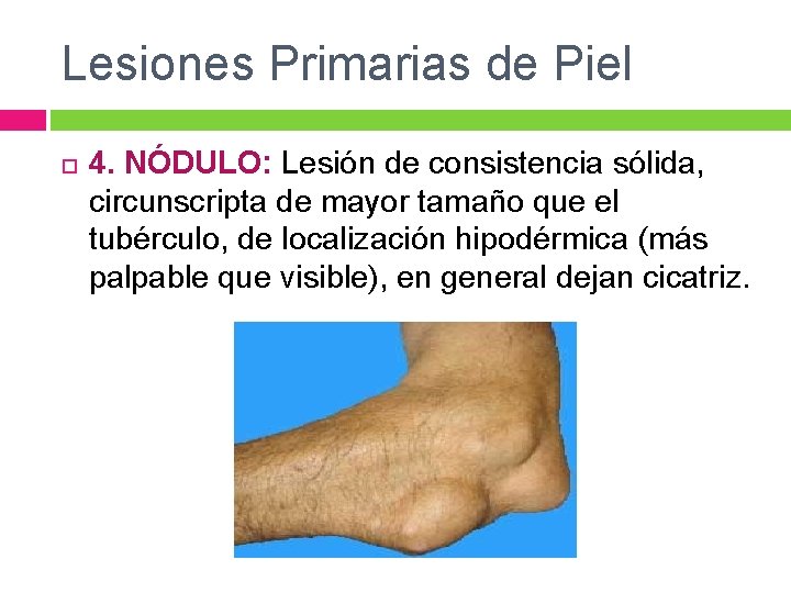 Lesiones Primarias de Piel 4. NÓDULO: Lesión de consistencia sólida, circunscripta de mayor tamaño