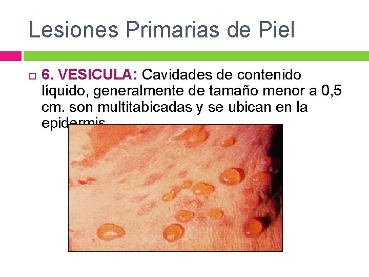 Lesiones Primarias de Piel 6. VESICULA: Cavidades de contenido líquido, generalmente de tamaño menor
