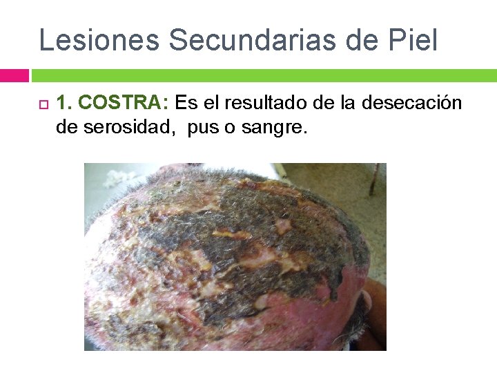 Lesiones Secundarias de Piel 1. COSTRA: Es el resultado de la desecación de serosidad,