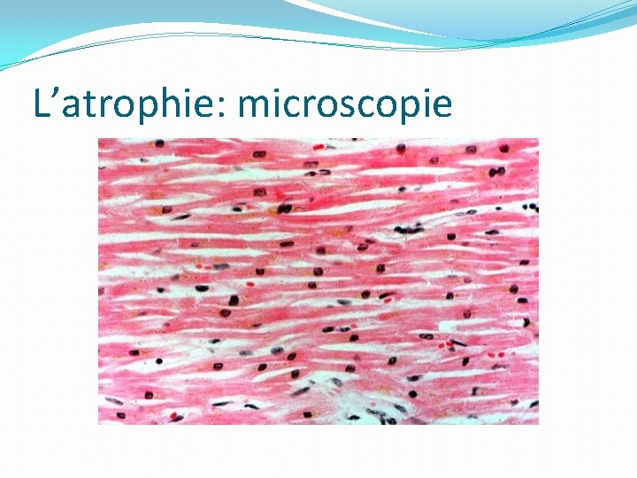 L’atrophie: microscopie 