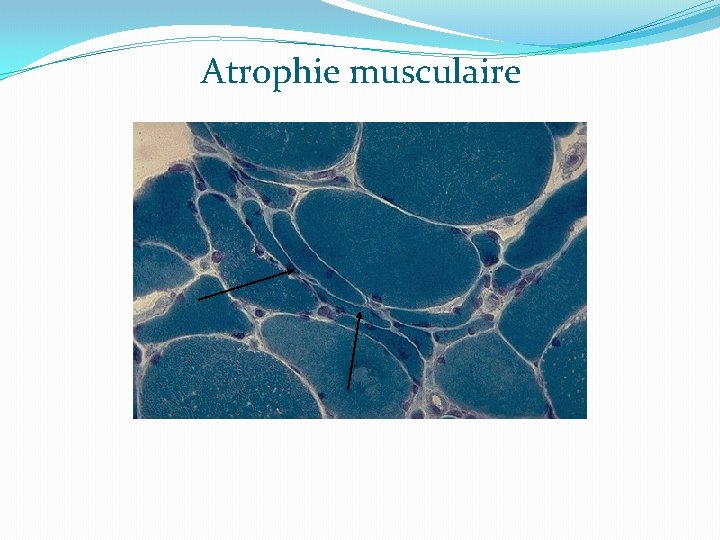 Atrophie musculaire 