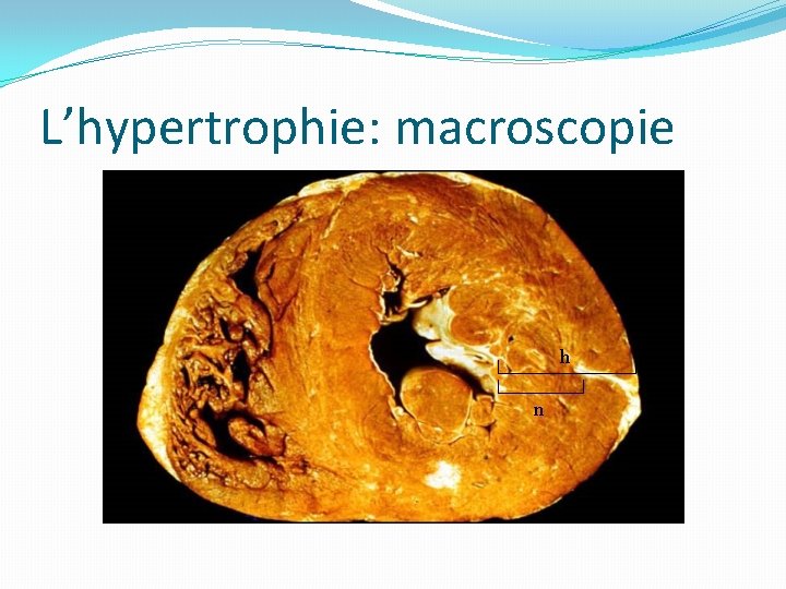 L’hypertrophie: macroscopie h n 