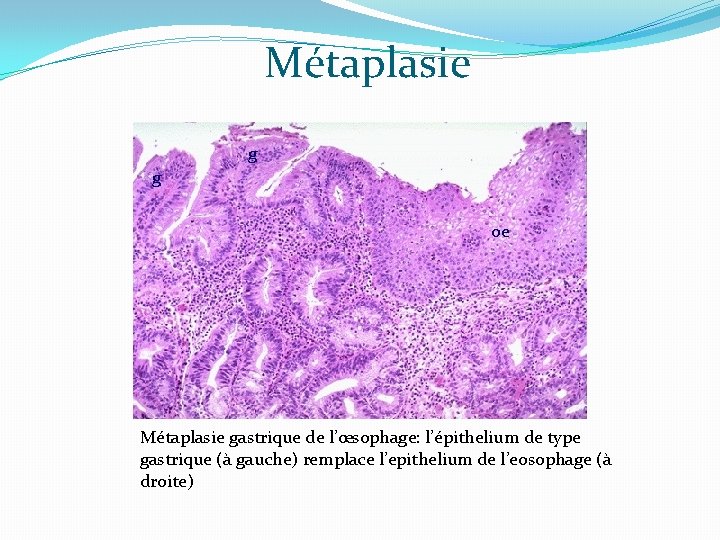 Métaplasie g g oe Métaplasie gastrique de l’œsophage: l’épithelium de type gastrique (à gauche)