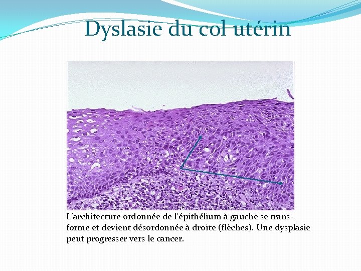 Dyslasie du col utérin L’architecture ordonnée de l’épithélium à gauche se transforme et devient