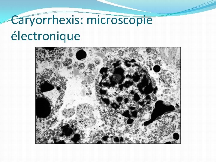 Caryorrhexis: microscopie électronique 