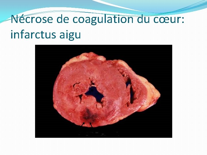 Nécrose de coagulation du cœur: infarctus aigu 