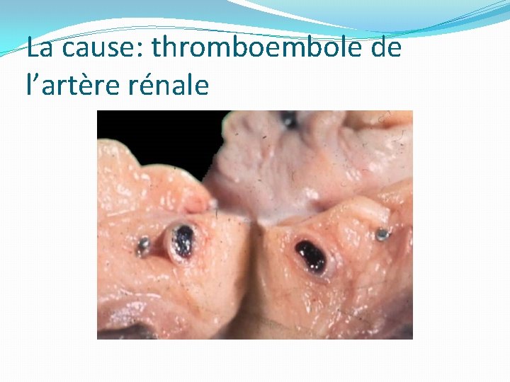 La cause: thromboembole de l’artère rénale 