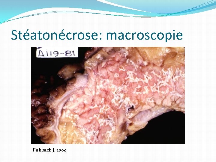 Stéatonécrose: macroscopie Fishback J, 2000 