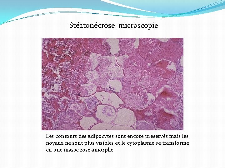 Stéatonécrose: microscopie Les contours des adipocytes sont encore préservés mais les noyaux ne sont