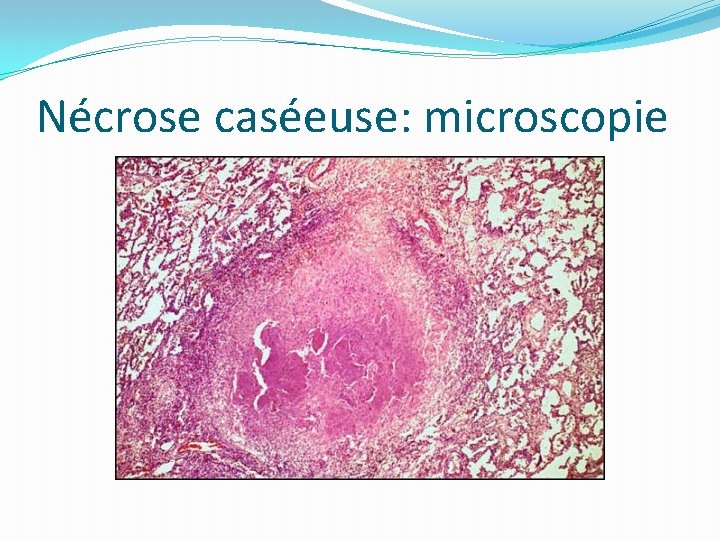 Nécrose caséeuse: microscopie 