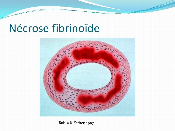 Nécrose fibrinoïde Rubin & Farber, 1997 