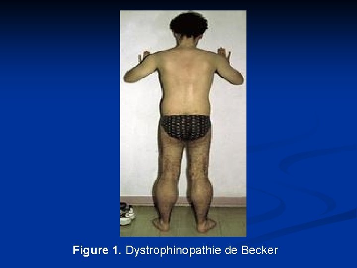 Figure 1. Dystrophinopathie de Becker 