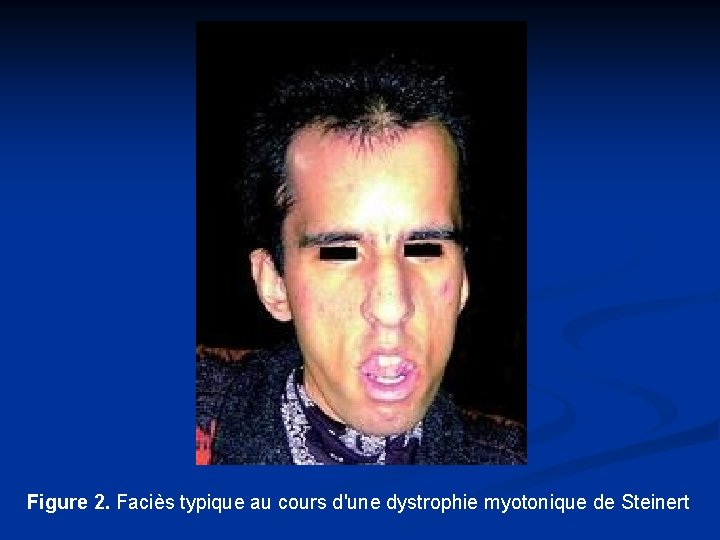 Figure 2. Faciès typique au cours d'une dystrophie myotonique de Steinert 