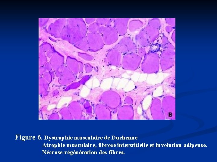 Figure 6. Dystrophie musculaire de Duchenne Atrophie musculaire, fibrose interstitielle et involution adipeuse. Nécrose-régénération