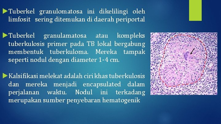  Tuberkel granulomatosa ini dikelilingi oleh limfosit sering ditemukan di daerah periportal Tuberkel granulamatosa