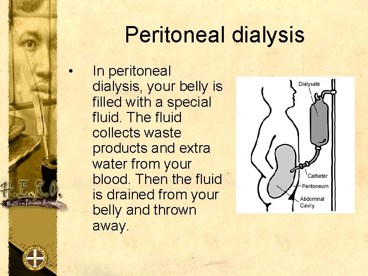 Peritoneal dialysis • In peritoneal dialysis, your belly is filled with a special fluid.