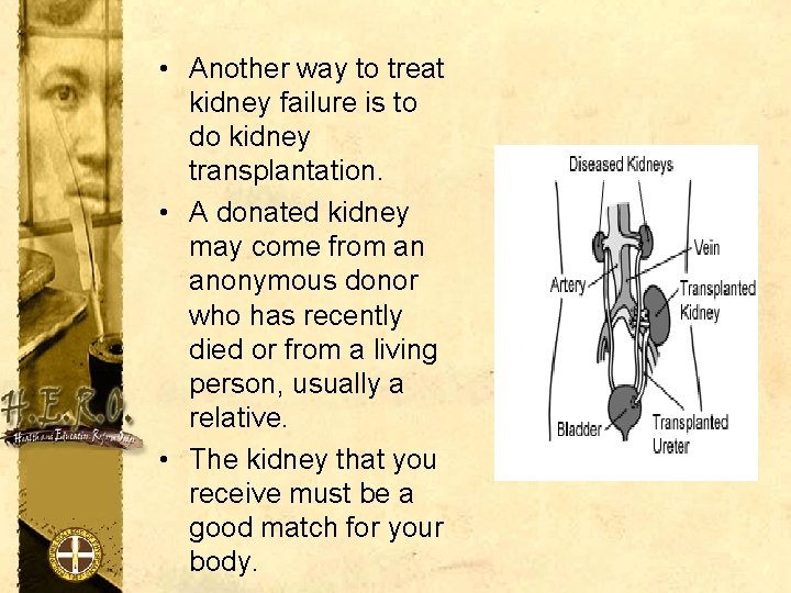  • Another way to treat kidney failure is to do kidney transplantation. •