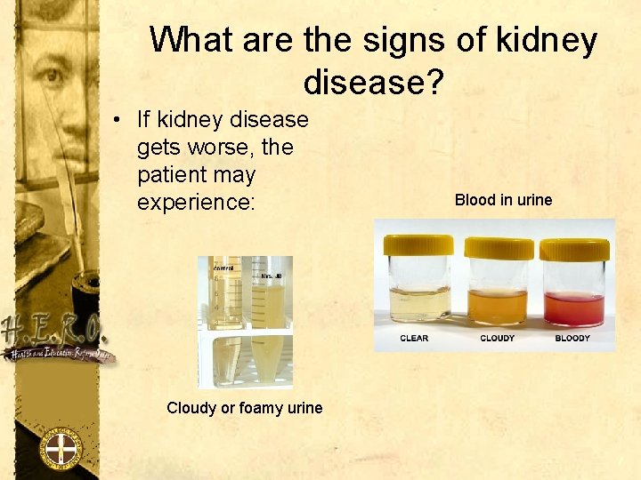 What are the signs of kidney disease? • If kidney disease gets worse, the