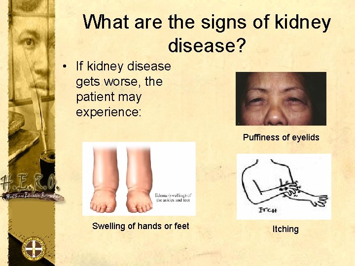 What are the signs of kidney disease? • If kidney disease gets worse, the