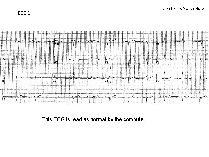 Elias Hanna, MD, Cardiology ECG 1 This ECG is read as normal by the