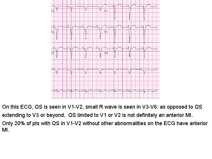 On this ECG, QS is seen in V 1 -V 2, small R wave
