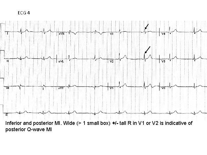 ECG 4 Inferior and posterior MI. Wide (> 1 small box) +/- tall R