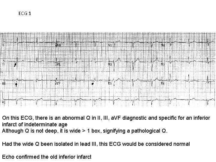 ECG 1 On this ECG, there is an abnormal Q in II, III, a.