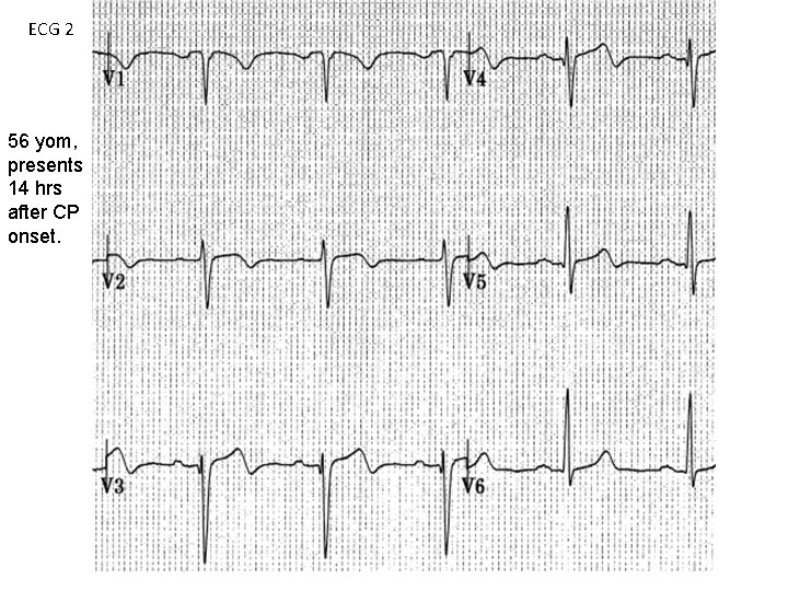 ECG 2 56 yom, presents 14 hrs after CP onset. 