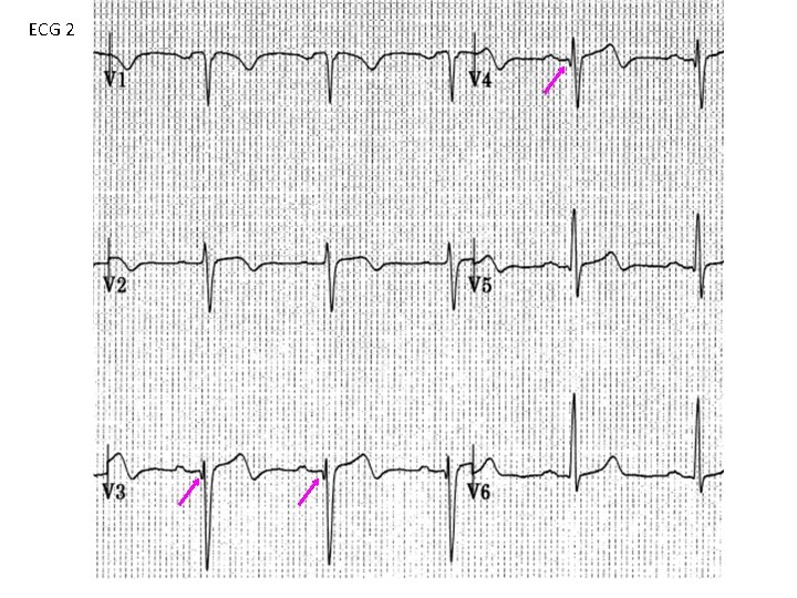 ECG 2 