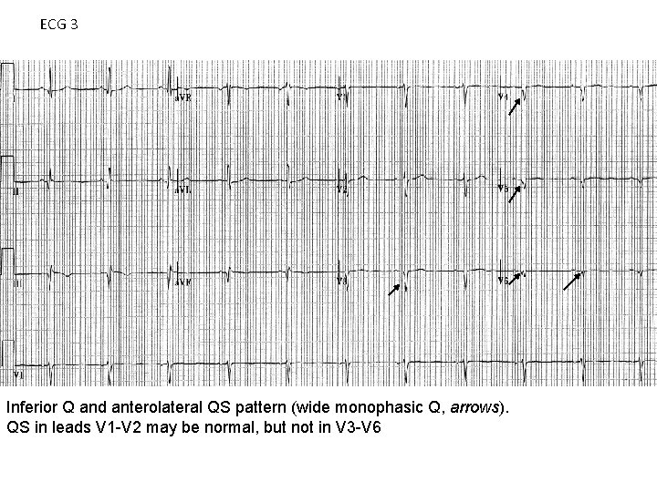ECG 3 Inferior Q and anterolateral QS pattern (wide monophasic Q, arrows). QS in