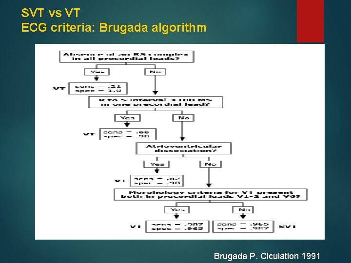 SVT vs VT ECG criteria: Brugada algorithm Brugada P. Ciculation 1991 