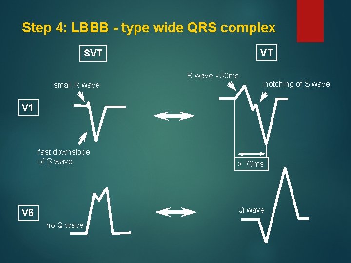 Step 4: LBBB - type wide QRS complex VT SVT R wave >30 ms