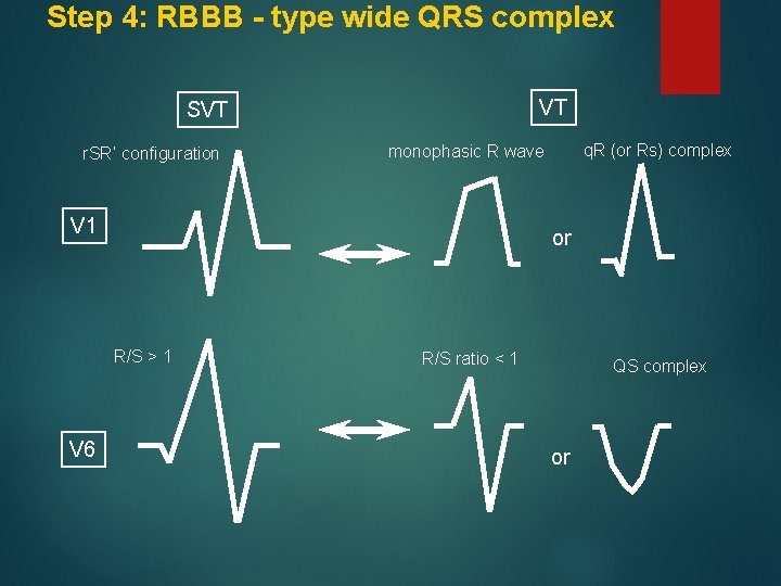 Step 4: RBBB - type wide QRS complex VT SVT r. SR’ configuration V