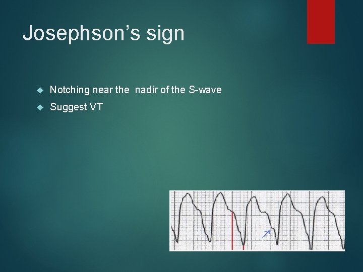 Josephson’s sign Notching near the nadir of the S-wave Suggest VT 