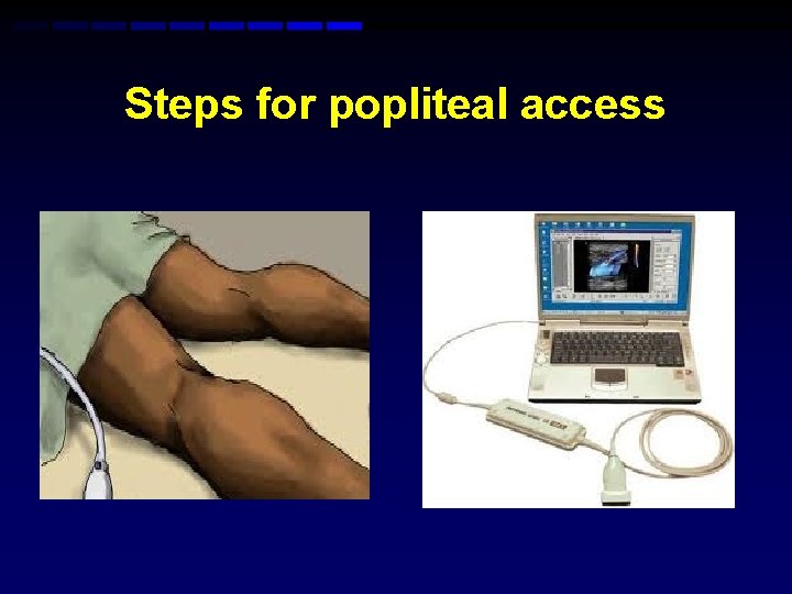 Steps for popliteal access Steps for popliteal access