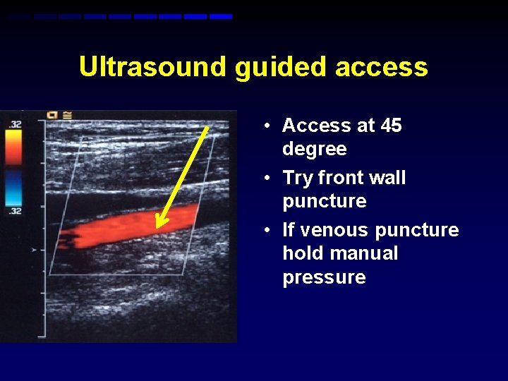 Ultrasound guided access • Access at 45 degree • Try front wall puncture • Ultrasound guided access • Access at 45 degree • Try front wall puncture •