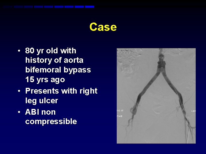 Case • 80 yr old with history of aorta bifemoral bypass 15 yrs ago Case • 80 yr old with history of aorta bifemoral bypass 15 yrs ago