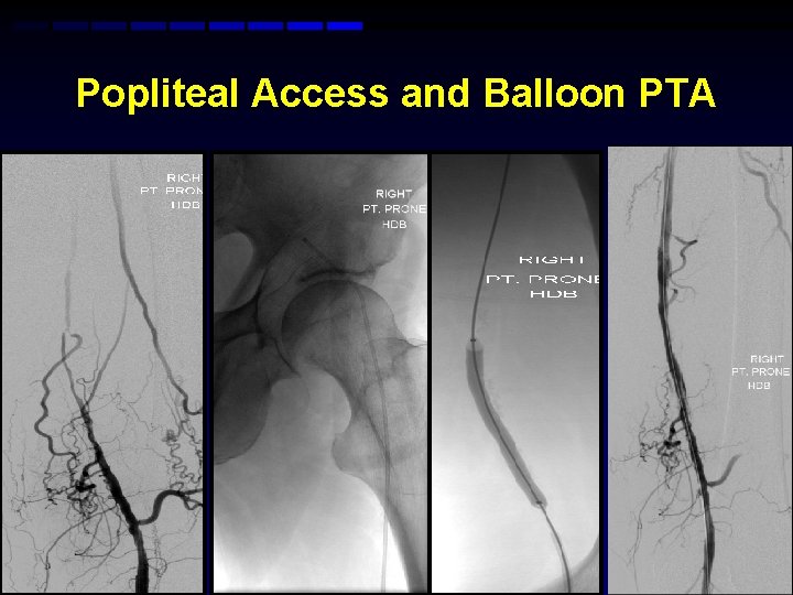 Popliteal Access and Balloon PTA Popliteal Access and Balloon PTA