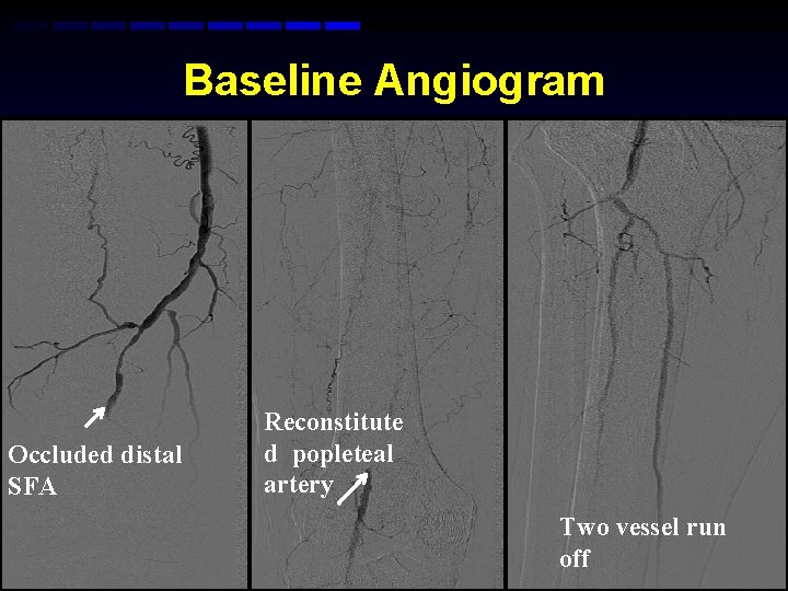 Baseline Angiogram Occluded distal SFA Reconstitute d popleteal artery Two vessel run off Baseline Angiogram Occluded distal SFA Reconstitute d popleteal artery Two vessel run off