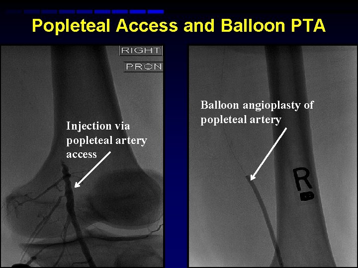 Popleteal Access and Balloon PTA Injection via popleteal artery access Balloon angioplasty of popleteal Popleteal Access and Balloon PTA Injection via popleteal artery access Balloon angioplasty of popleteal