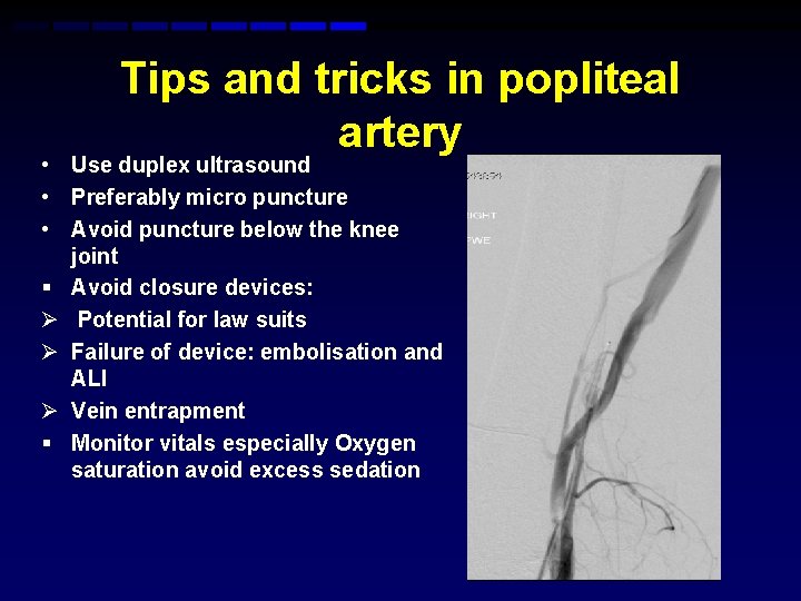 Tips and tricks in popliteal artery • Use duplex ultrasound • Preferably micro puncture Tips and tricks in popliteal artery • Use duplex ultrasound • Preferably micro puncture