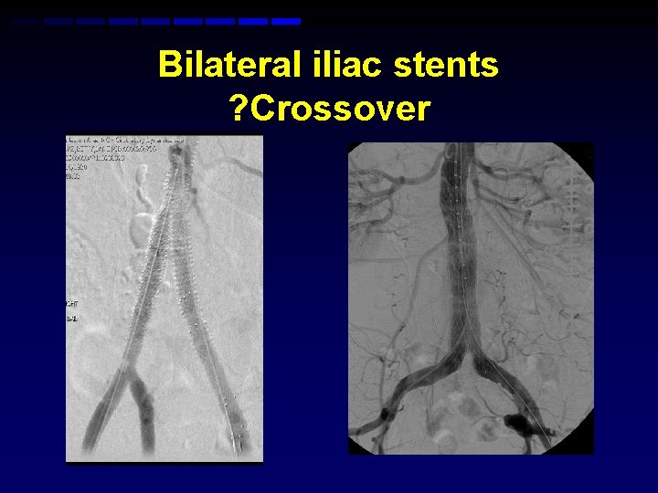 Bilateral iliac stents ? Crossover Bilateral iliac stents ? Crossover