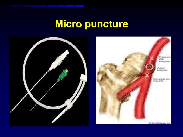 Micro puncture Micro puncture