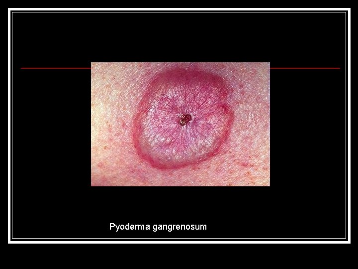 Pyoderma gangrenosum 