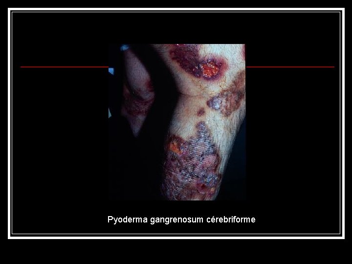 Pyoderma gangrenosum cérebriforme 