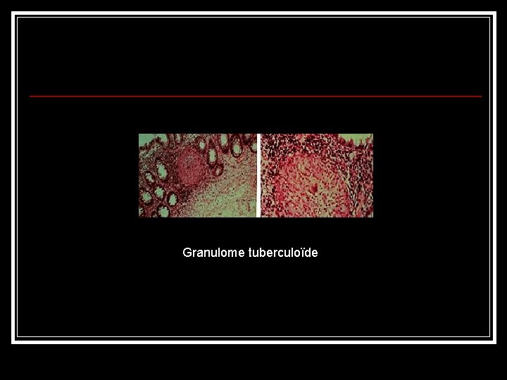 Granulome tuberculoïde 